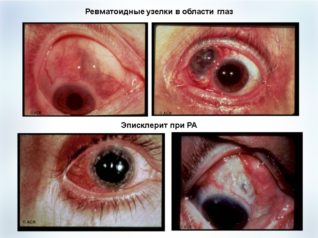 Эписклерит при РА Ревматоидные узелки в области глаз